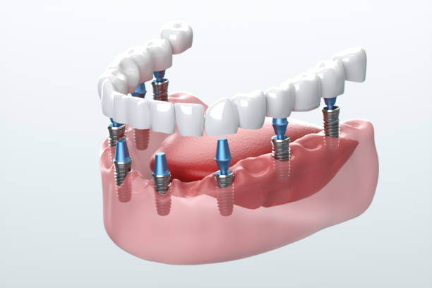 All-On-4 Dental Implants Financing